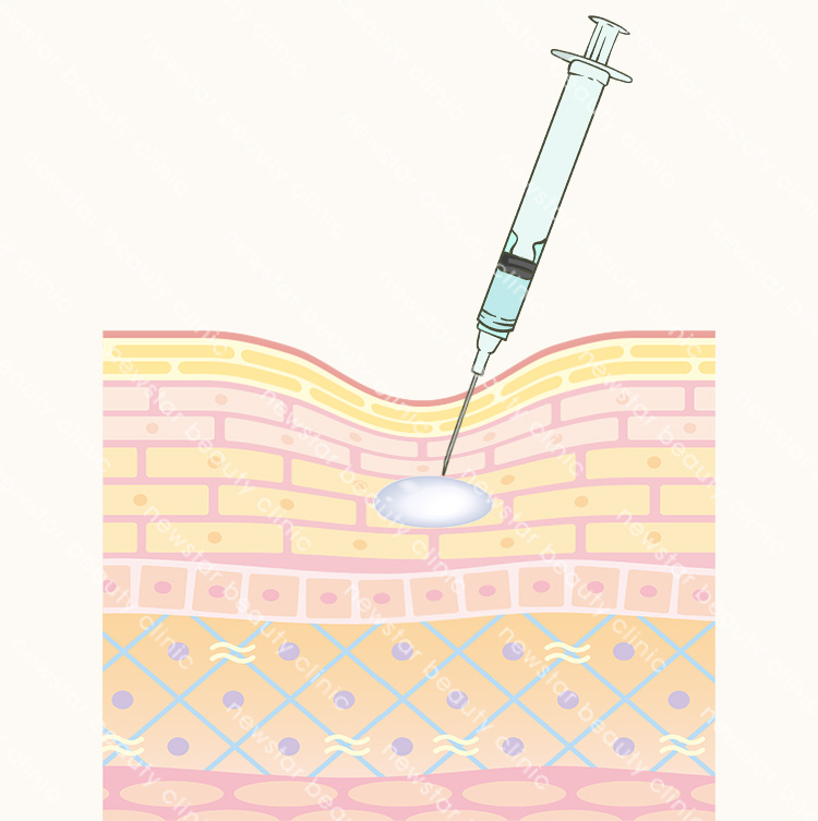 於凹陷處注入適當玻尿酸