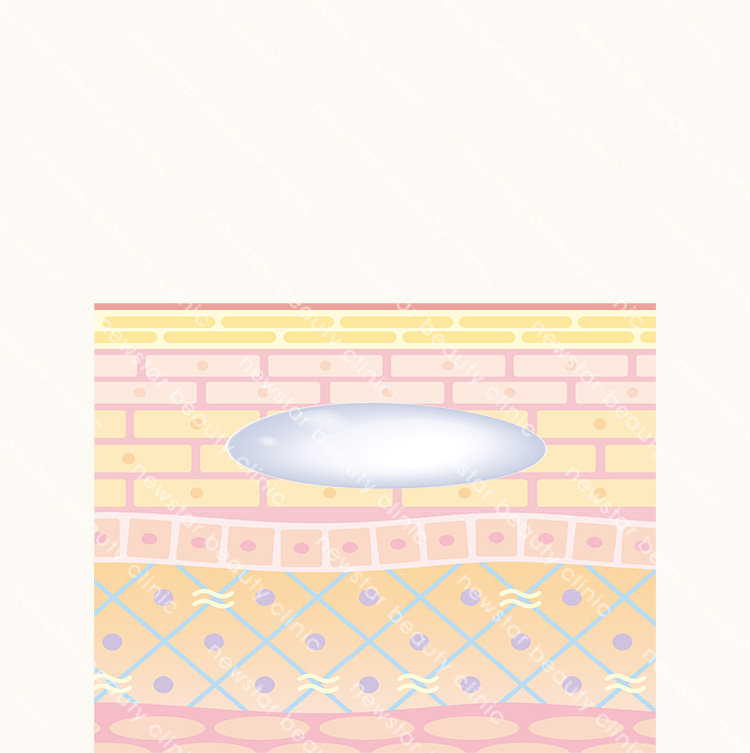 玻尿酸施打後，立即填補凹陷