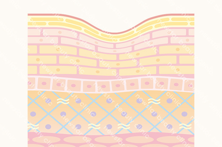 玻尿酸施打前，皮膚凹陷