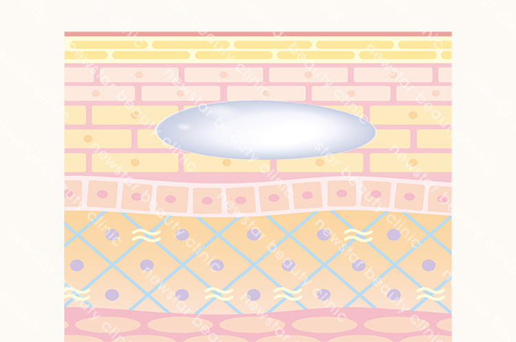 玻尿酸施打後，立即填補凹陷