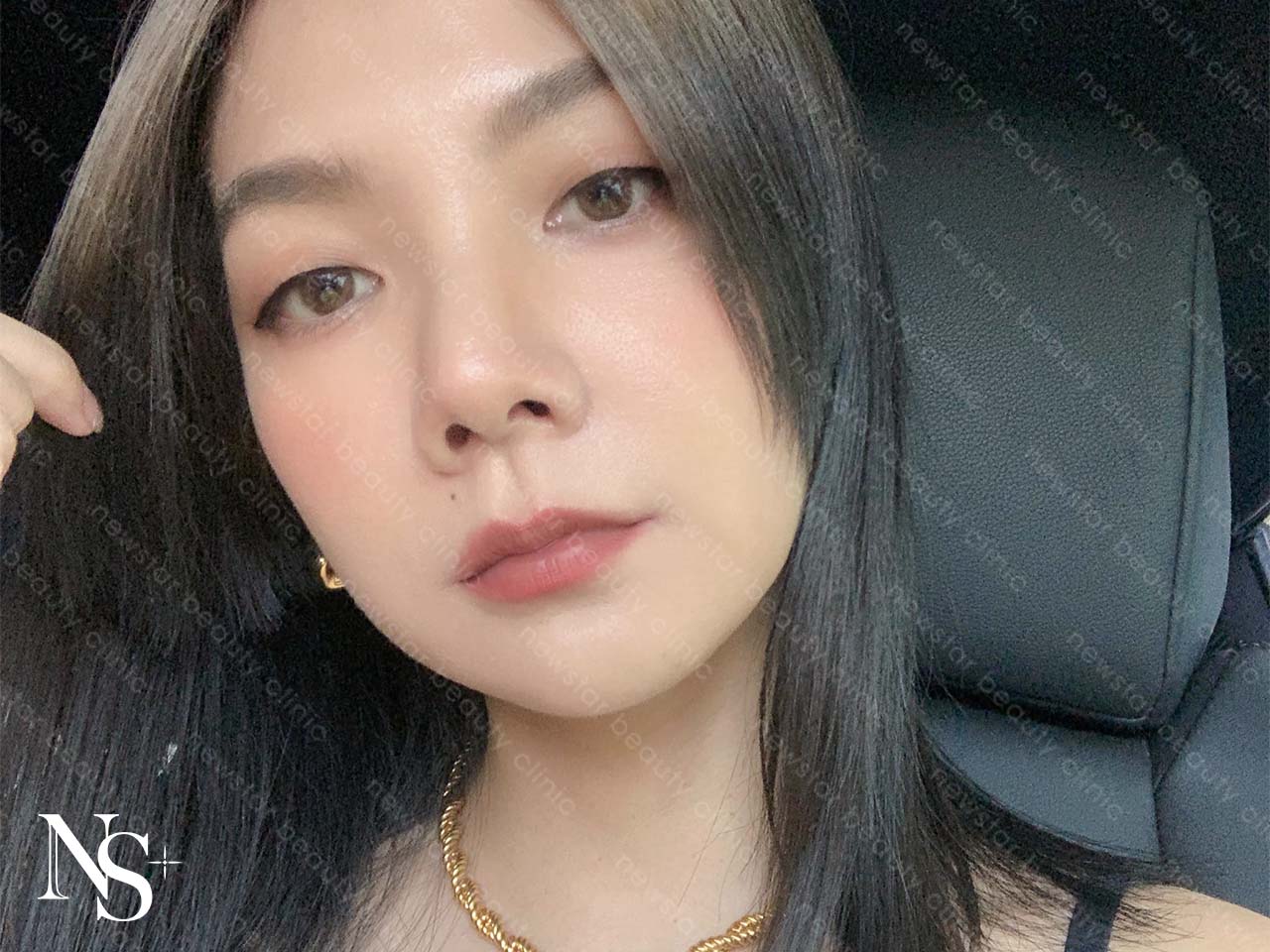 玻尿酸注射_欣莘醫美_好評回饋