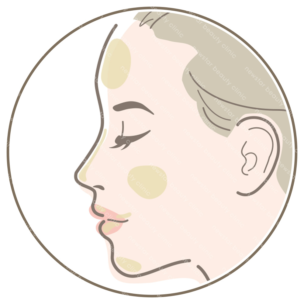 玻尿酸適合對象－欲精雕輪廓立體者