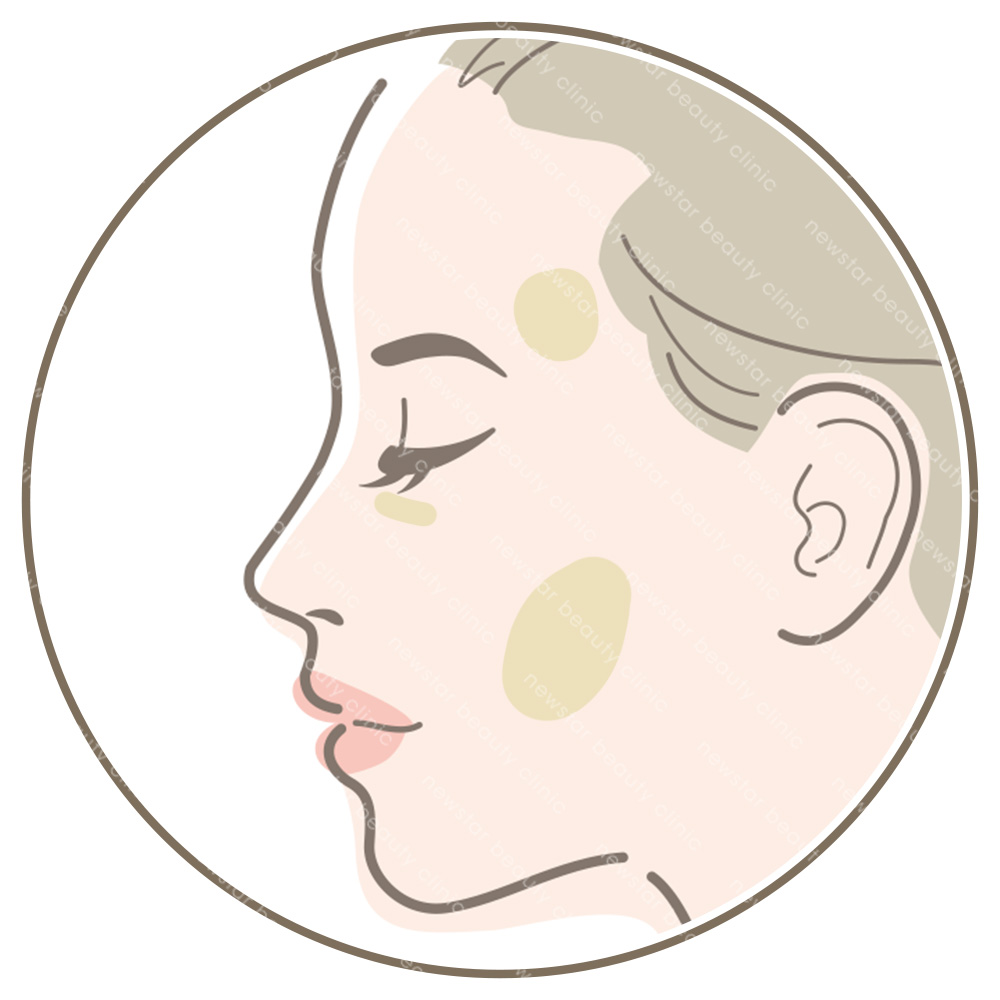 玻尿酸適合對象_欲填補局部凹陷者