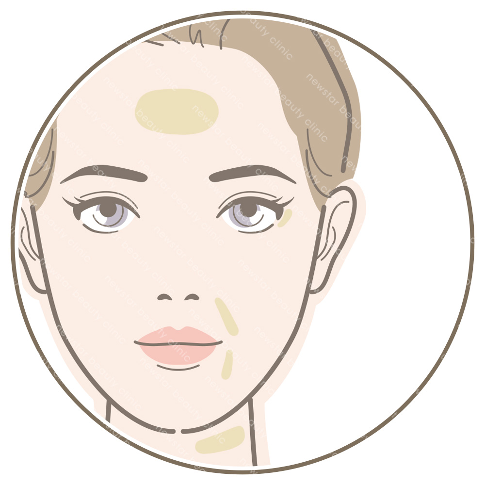 玻尿酸適合對象_欲撫平深淺紋路者