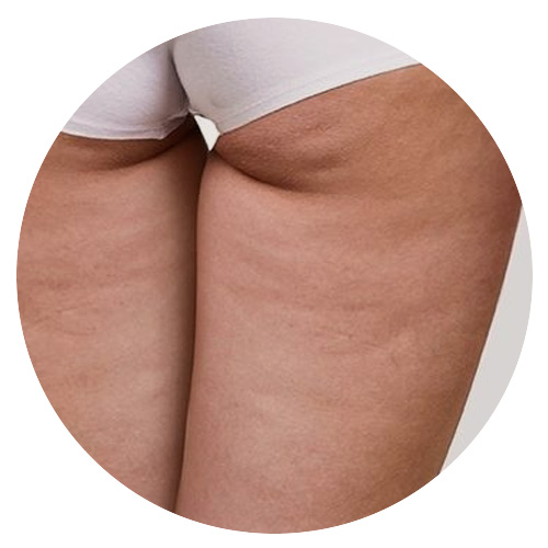 皮膚狀況_凹凸不平