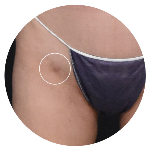 皮膚狀況_色素沉澱