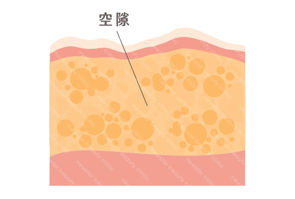 抽脂術後恢復_空隙