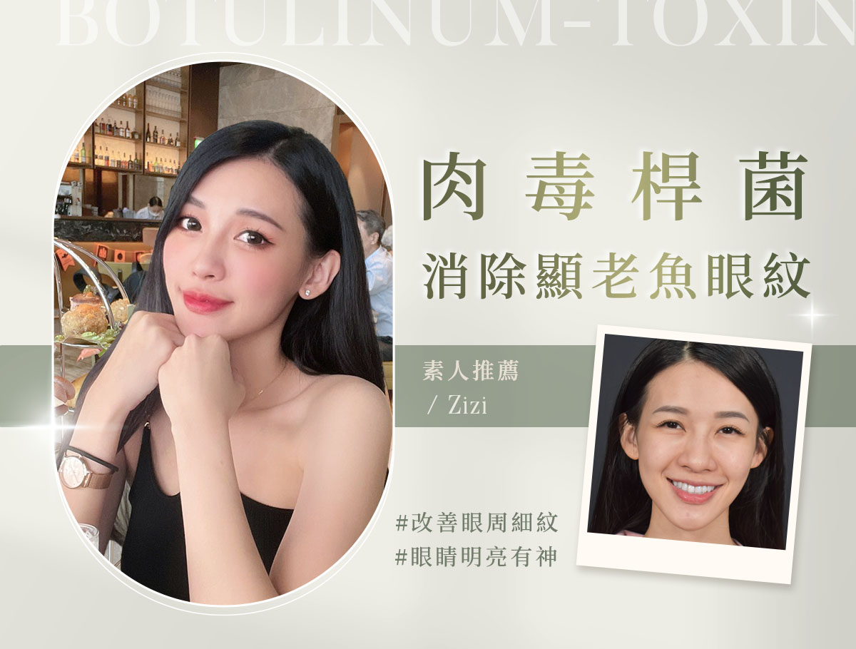 肉毒_微整官網案例(外BN)_姿姿
