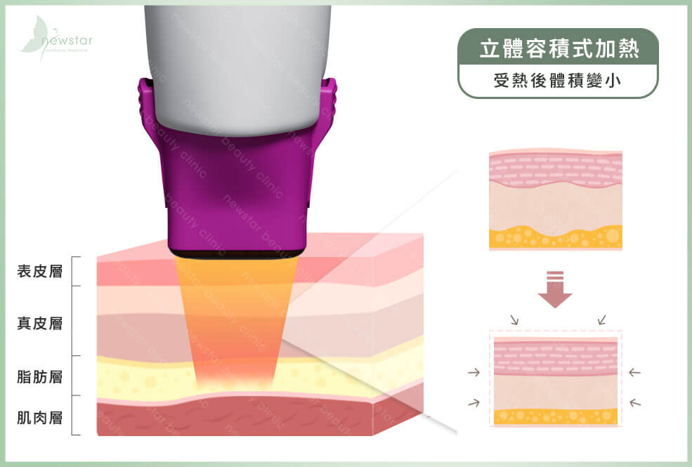 電波拉提_作用原理方式