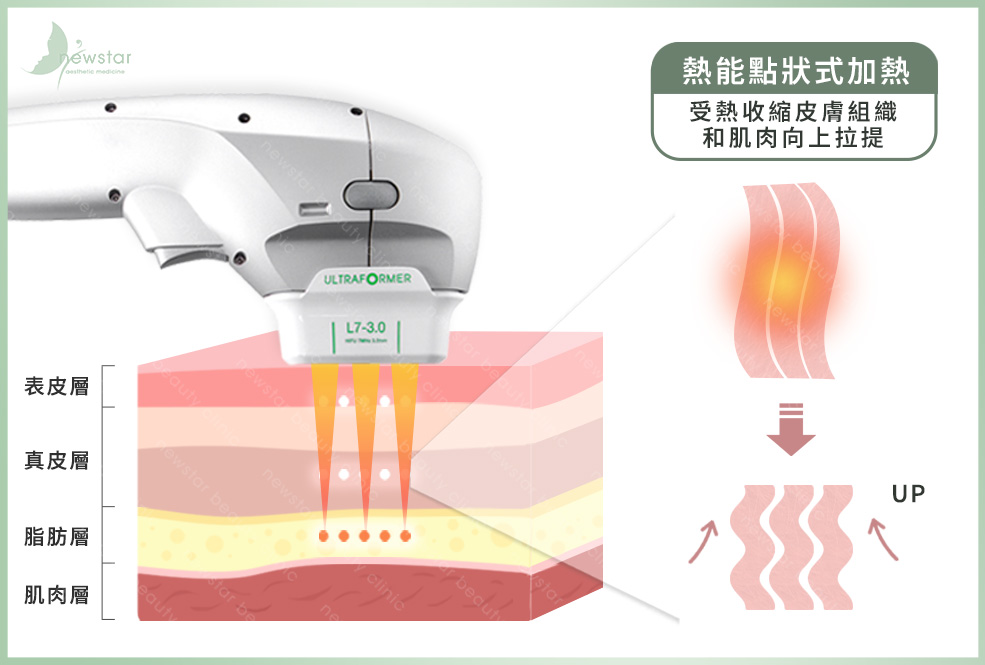 音波拉提_作用原理方式