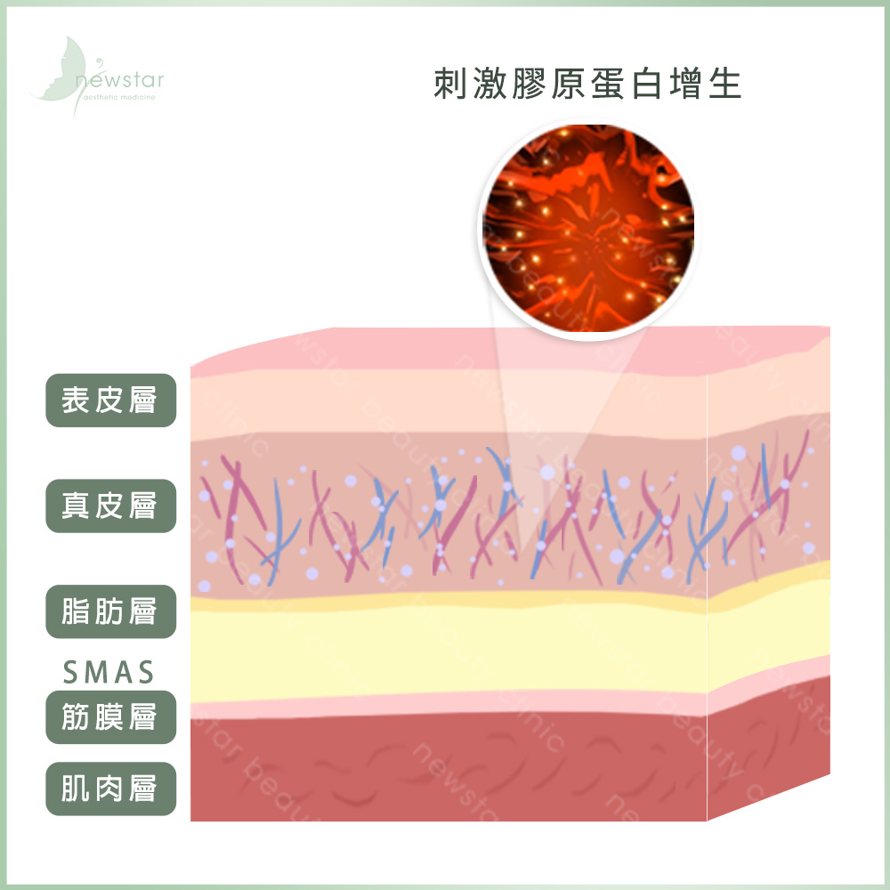 音波拉提_作用原理_刺激膠原蛋白