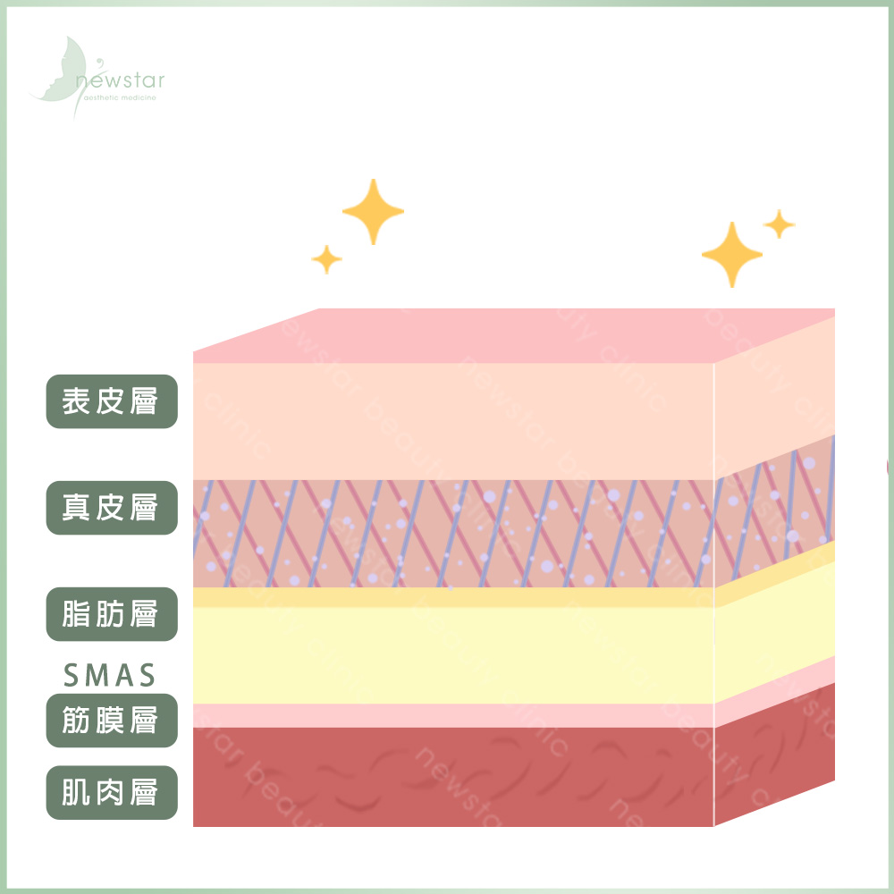 音波拉提_作用原理_施打後3個月