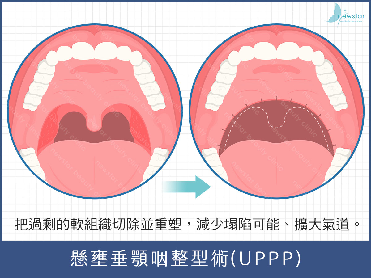 止鼾、打呼手術治療