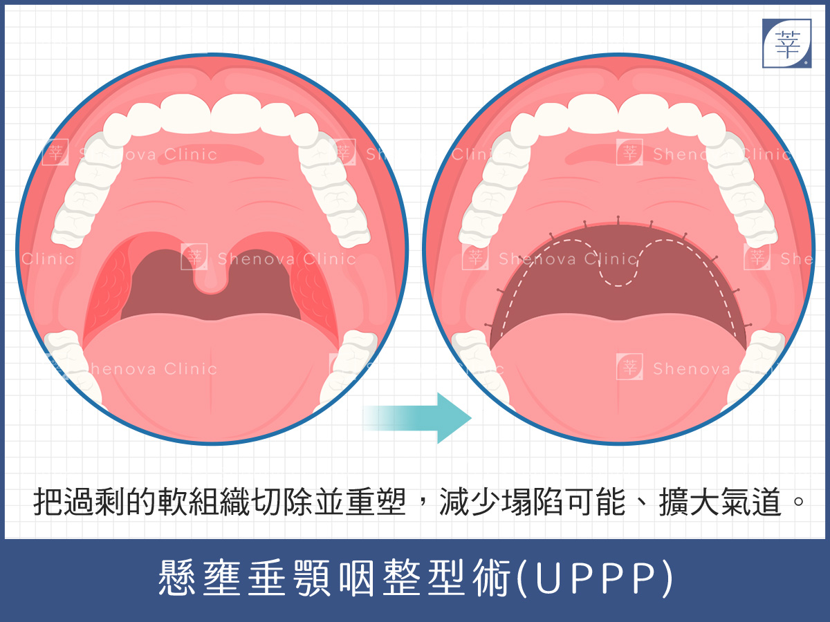 止鼾、打呼手術治療