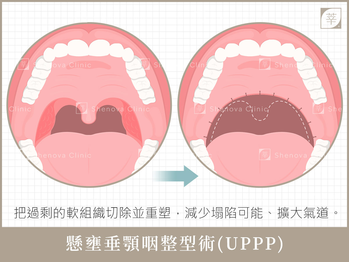 懸壅垂顎咽整型術(新)