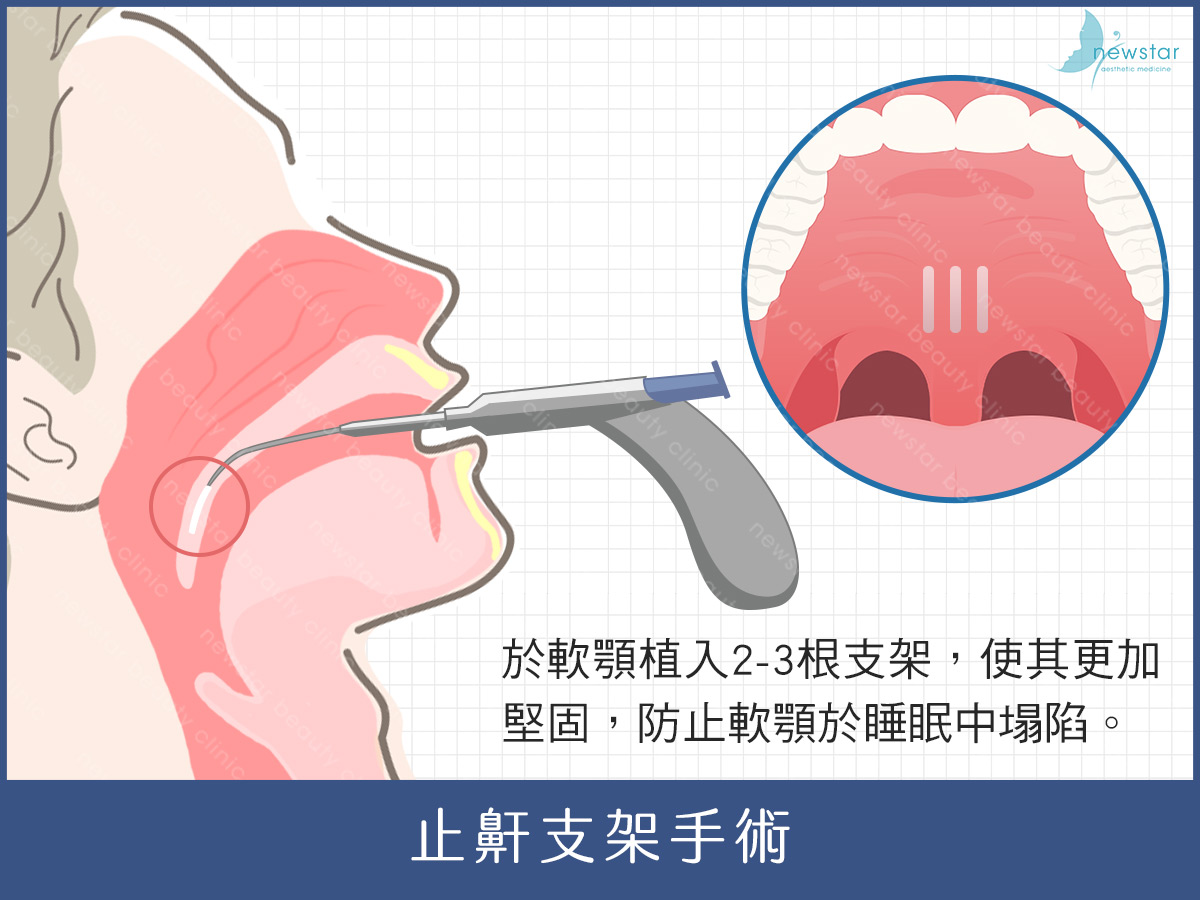 止鼾、打呼治療、止鼾支架手術