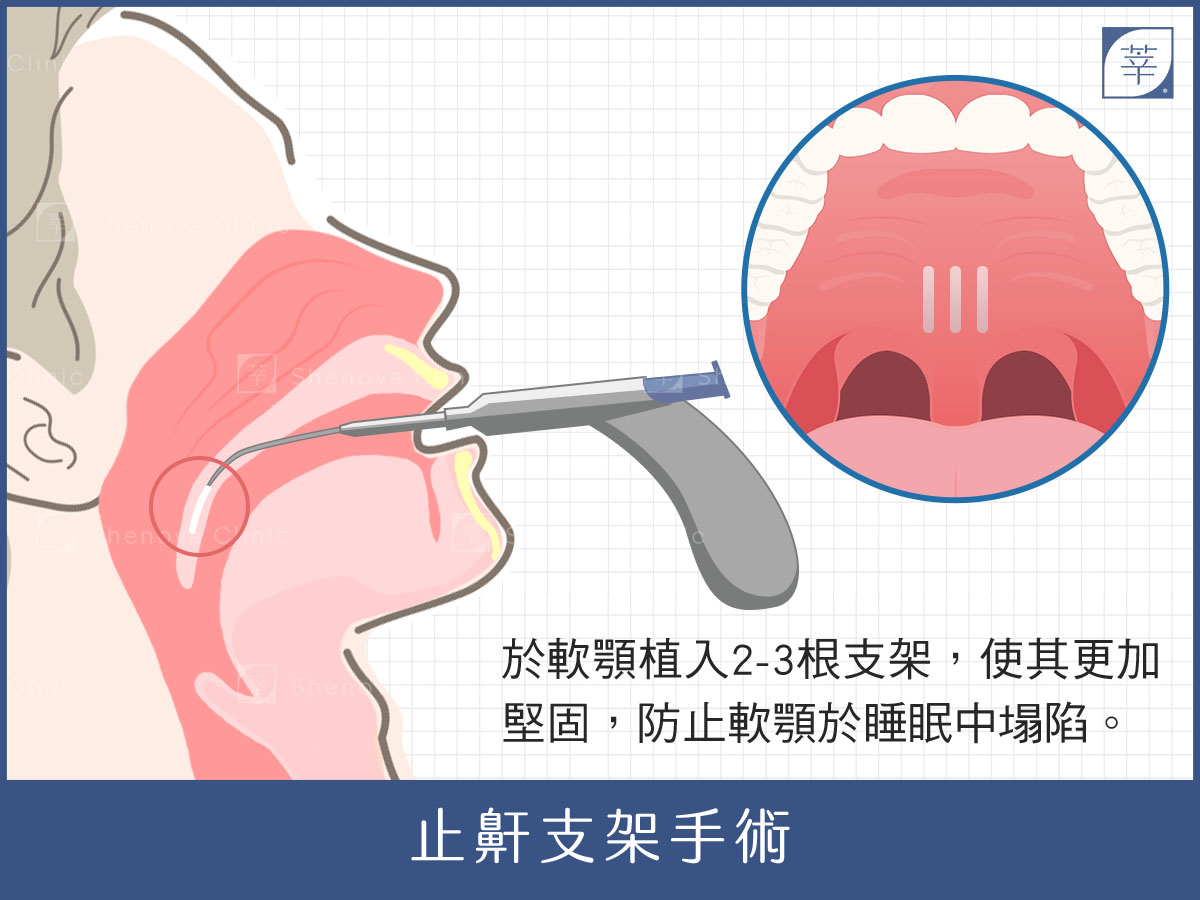 止鼾、打呼治療、止鼾支架手術