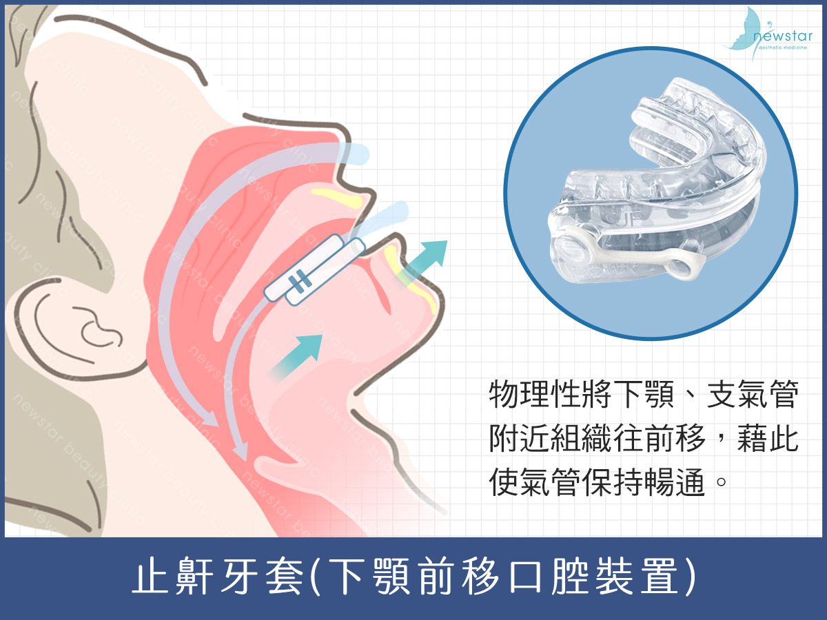止鼾牙套、打呼治療