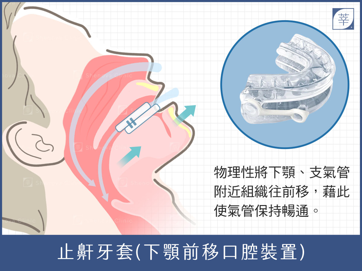 止鼾牙套、打呼治療