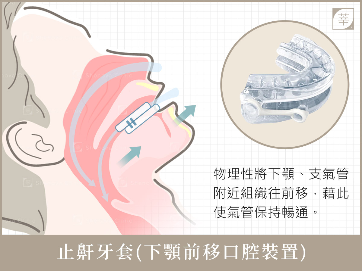 止鼾雷射_止鼾牙套(新)