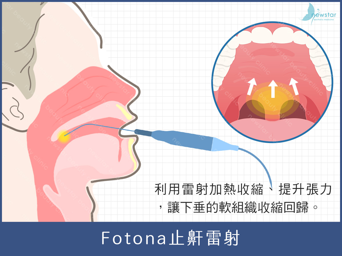 止鼾、打呼治療、止鼾雷射治療