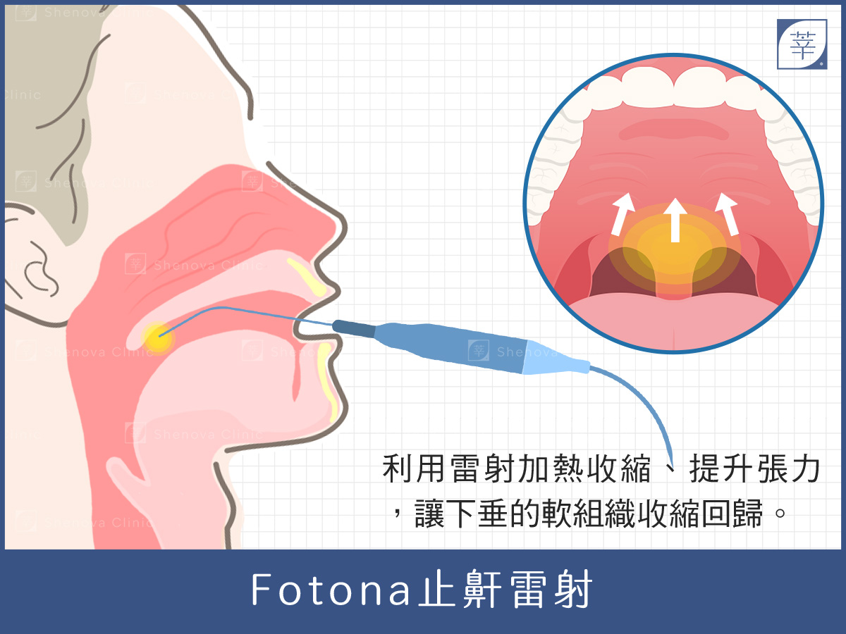 止鼾、打呼治療、止鼾雷射治療