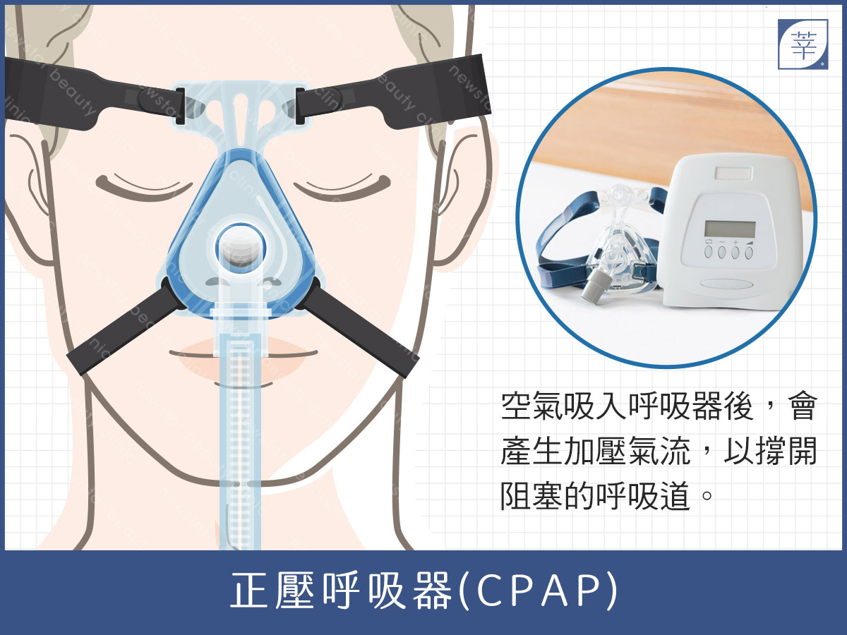 止鼾、打呼治療、正壓呼吸器
