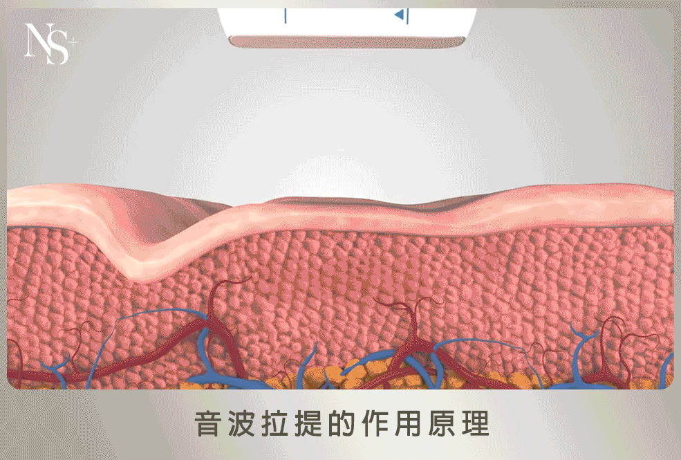 03音波拉提gif