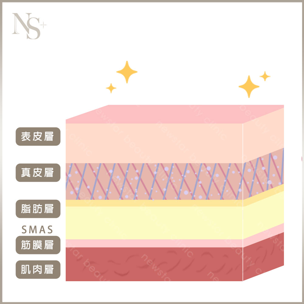 音波拉提個月效果_3個月術後