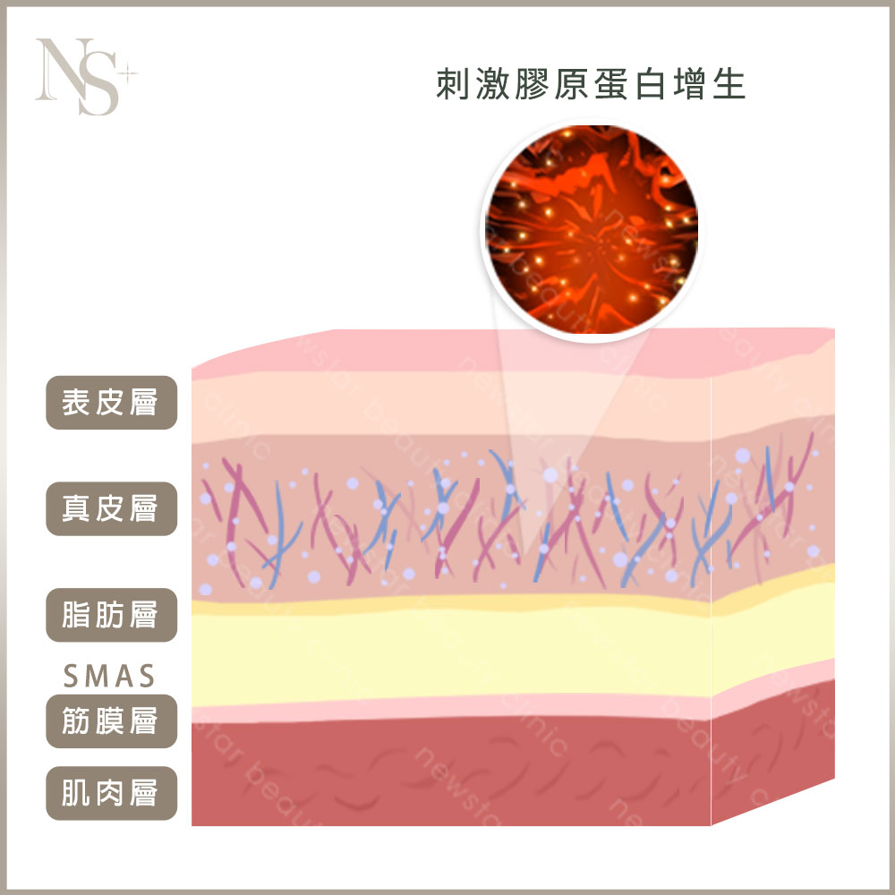 音波拉提個月效果_術中