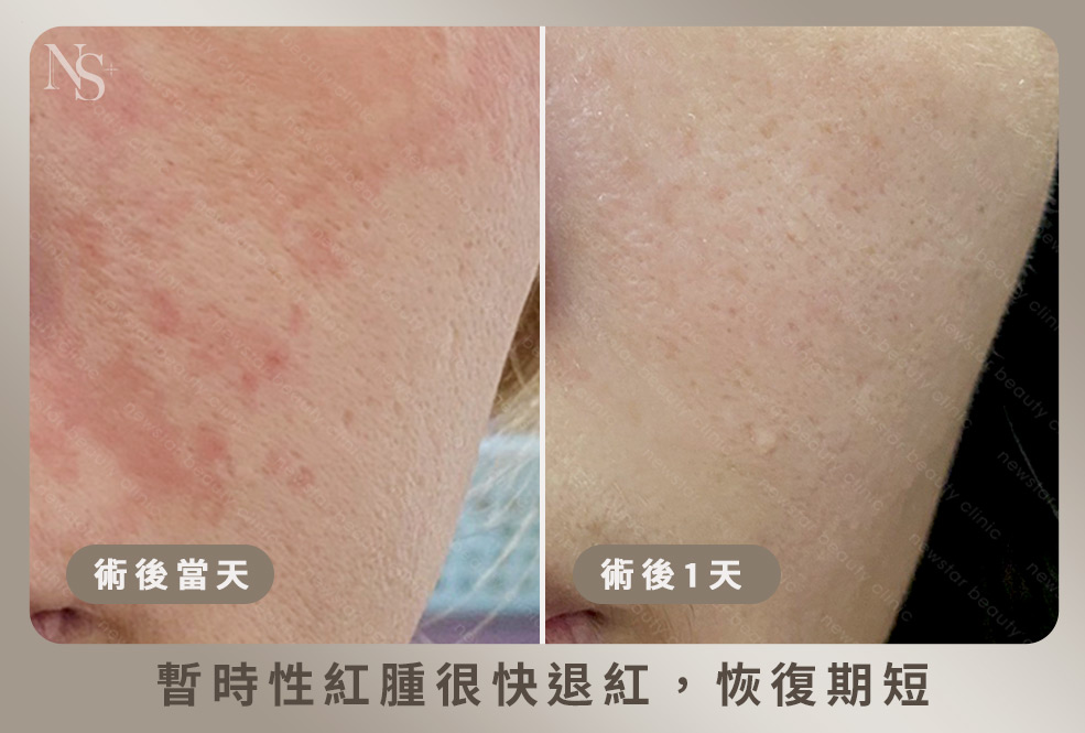 音波術後恢復多久