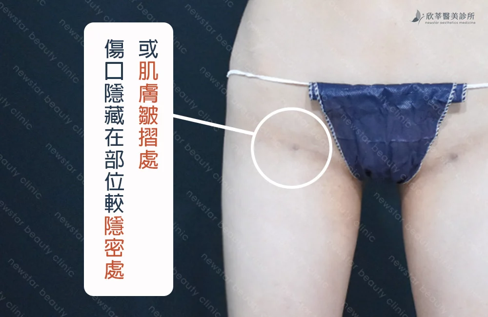 抽脂手術_傷口大小