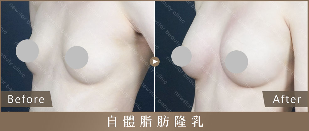自體脂肪隆乳_補案例03