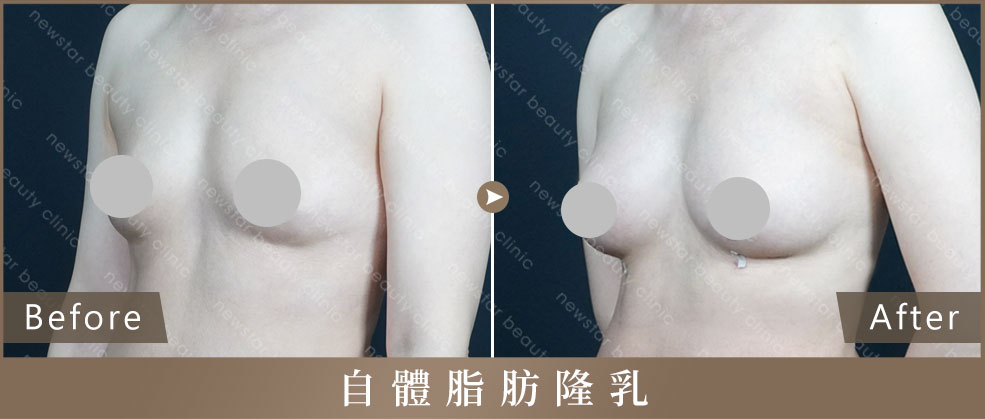 自體脂肪隆乳_補案例05