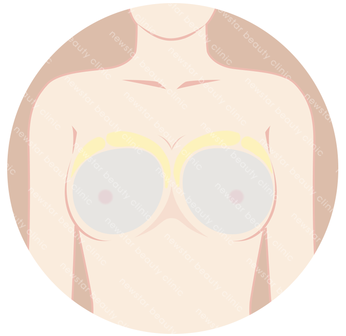 適合自體脂肪隆乳的人_假體隆乳+自體隆乳