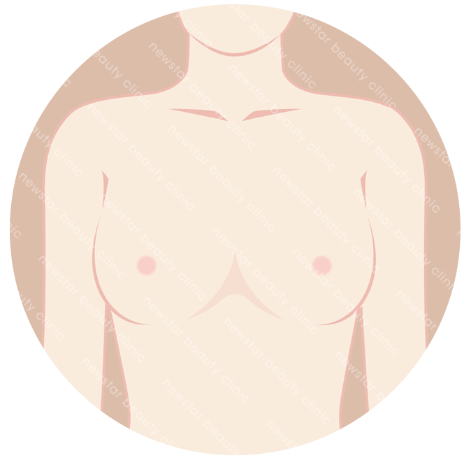 適合自體脂肪隆乳的人_天生發育不良