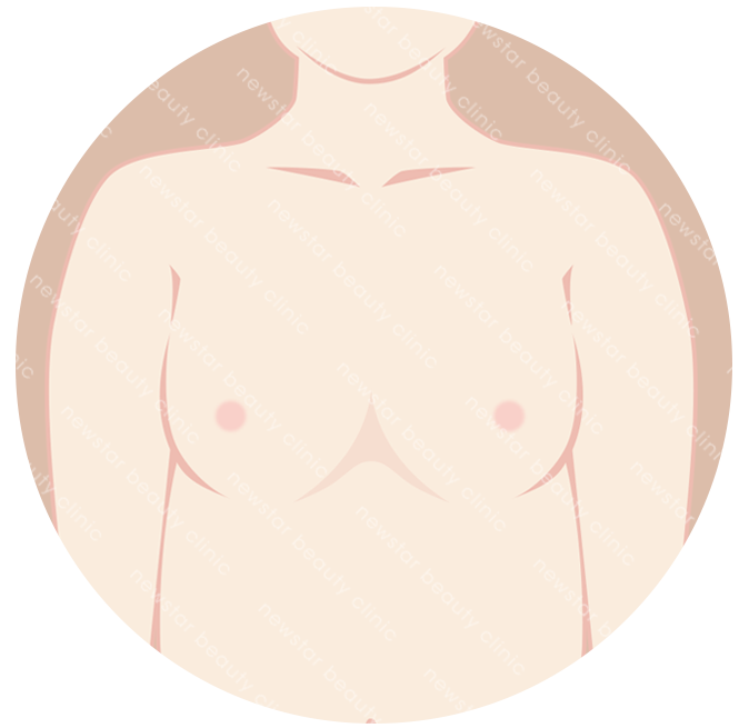 適合自體脂肪隆乳的人_減肥瘦身