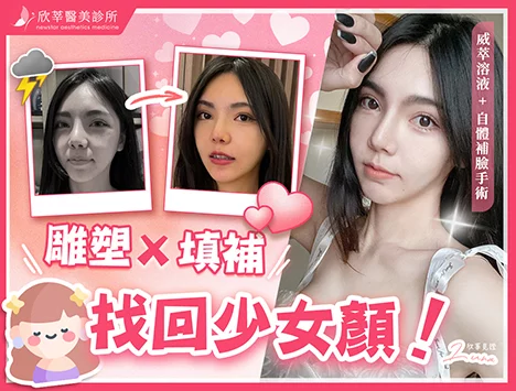 自體脂肪補臉