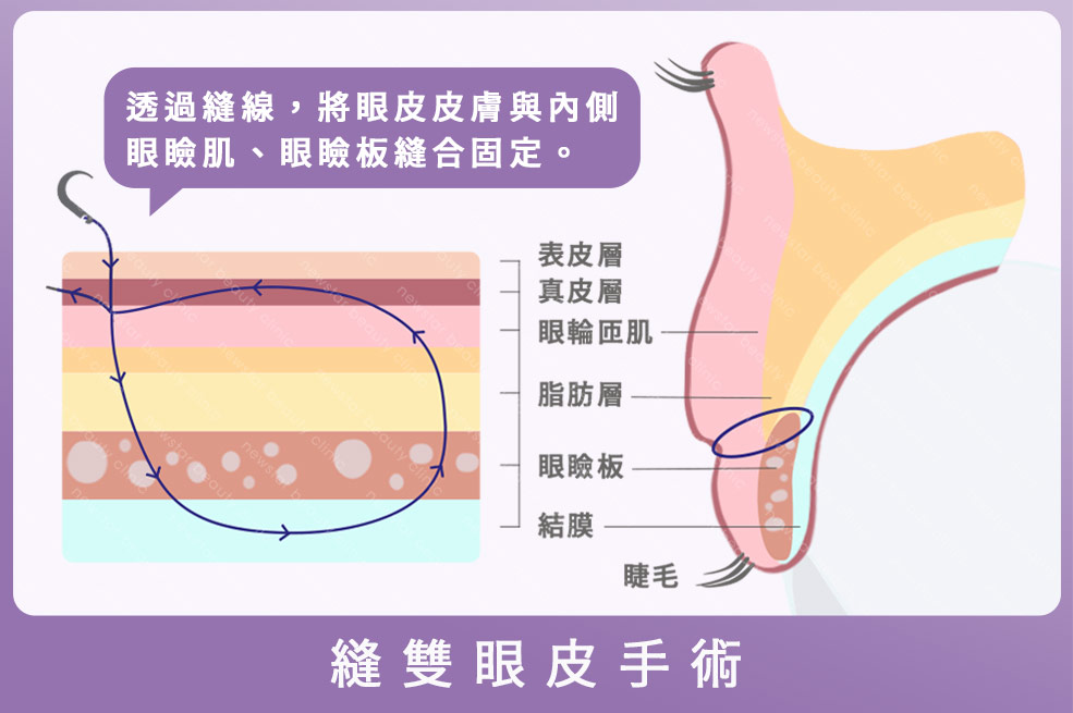 縫雙眼皮手術_上眼皮縫合肌肉層