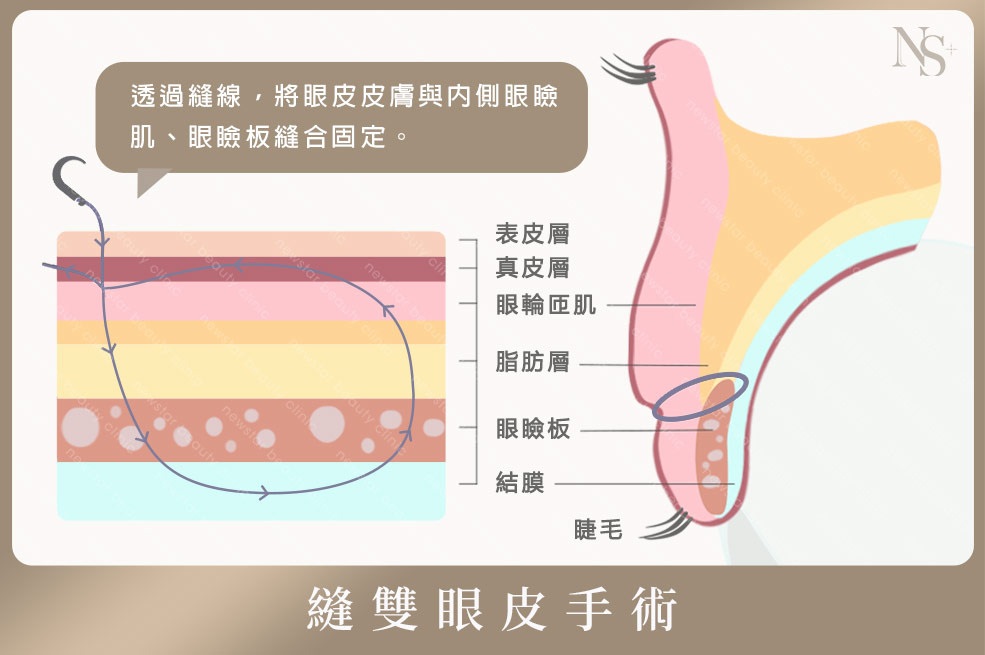 上眼皮切割面(咖)01