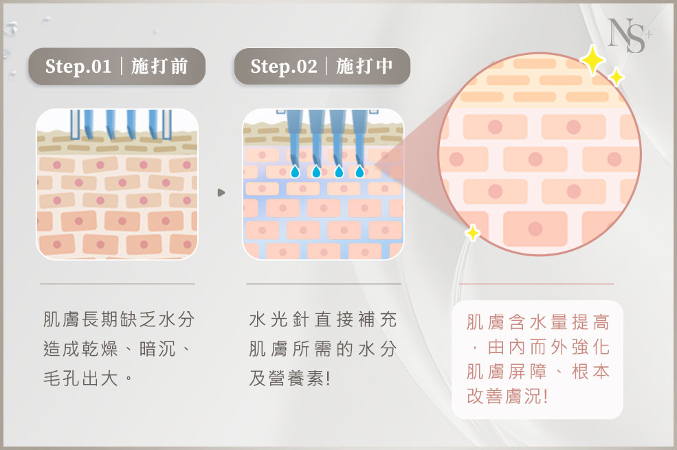 水光針水光槍原理介紹