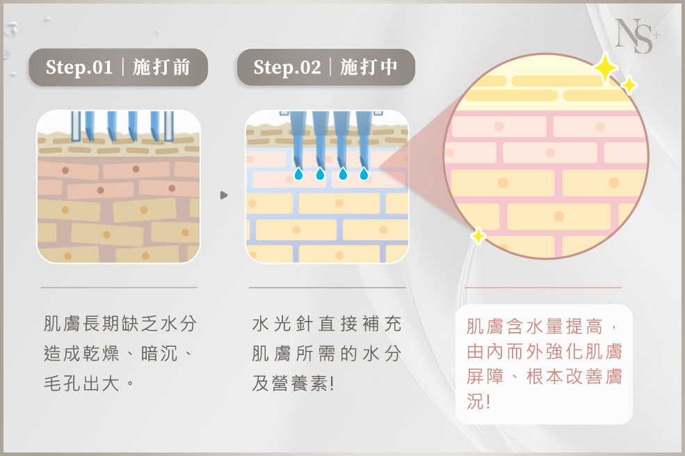 水光針原理施打過程介紹02