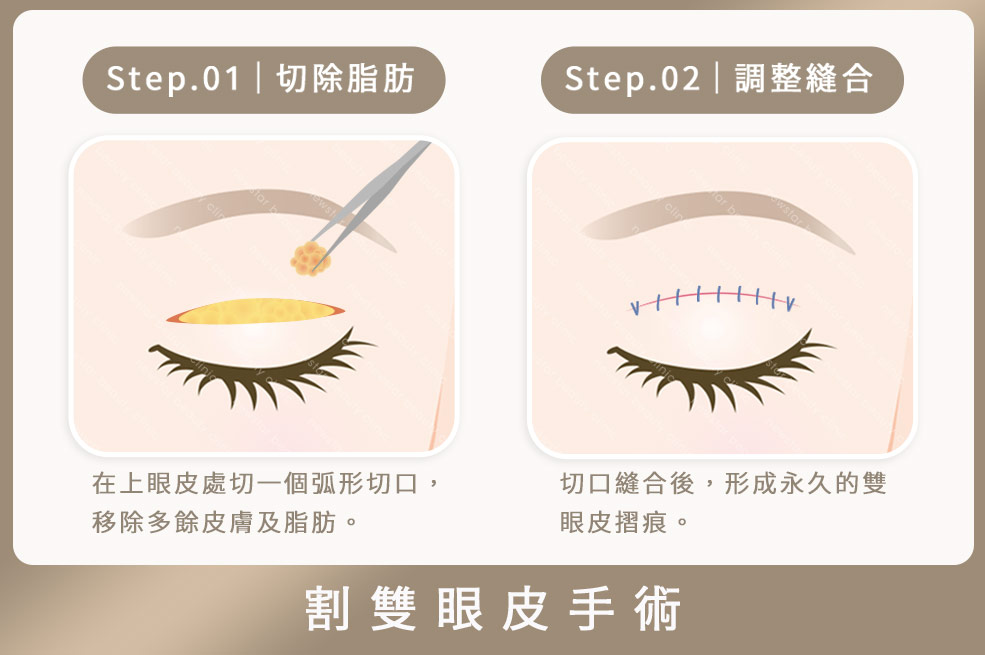 割雙眼皮(咖)01