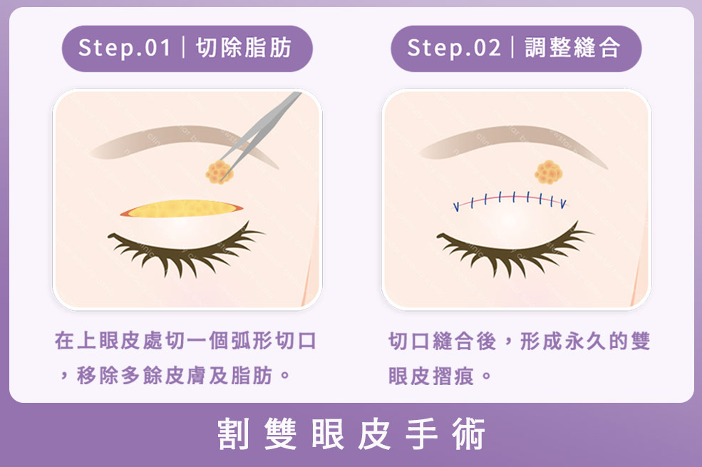 割雙眼皮手術流程