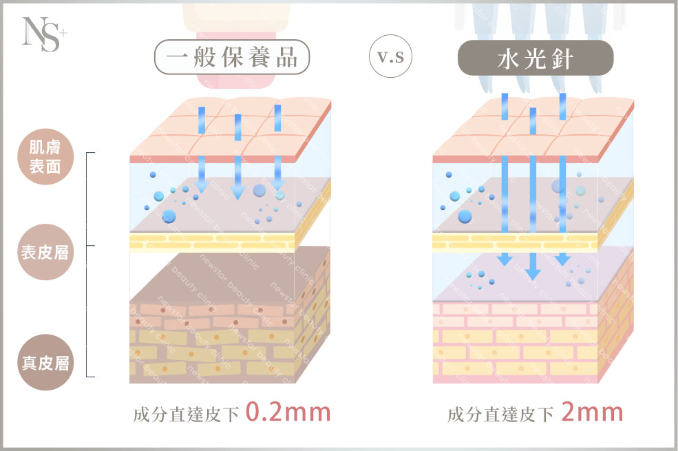水光針VS保養品差異