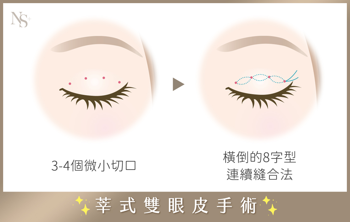 縫雙眼皮手術_莘式