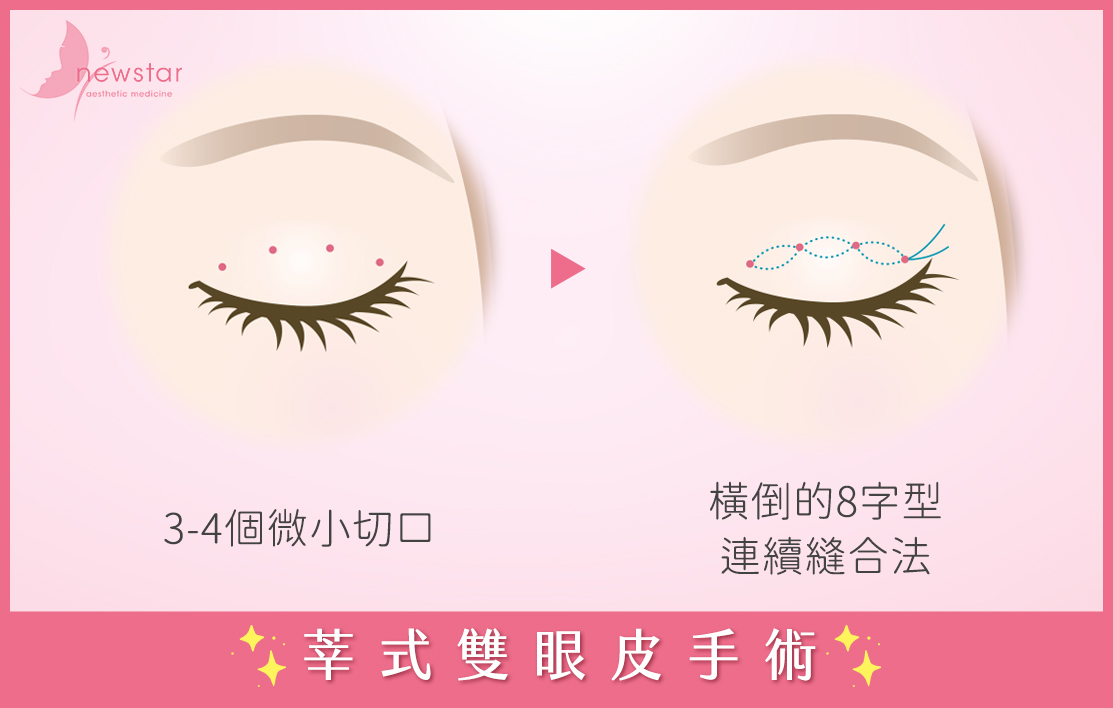莘式割、縫雙眼皮手術