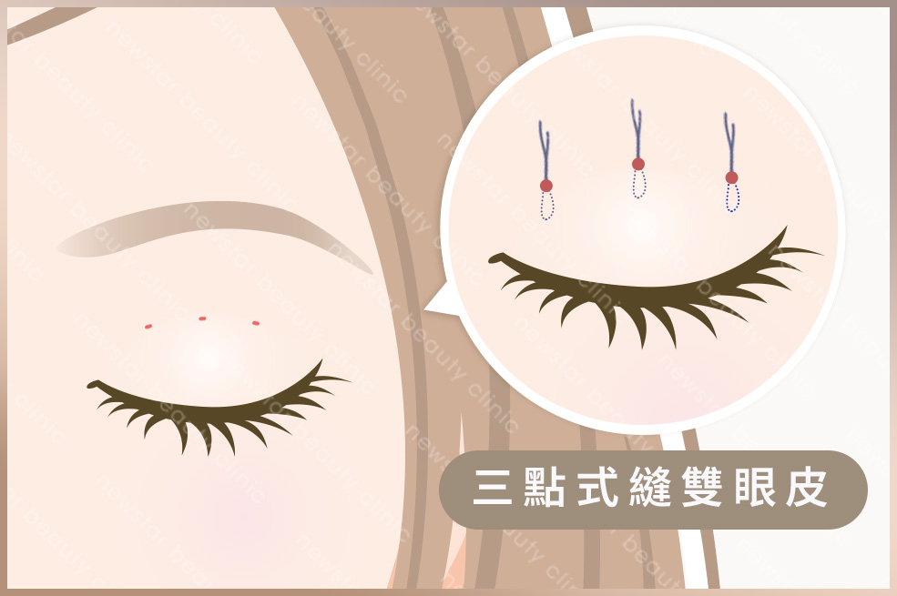 雙眼皮術式(咖)_三點式縫雙眼皮