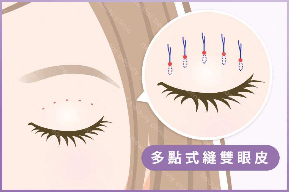 縫雙眼皮手術術式＿多點式縫雙眼皮