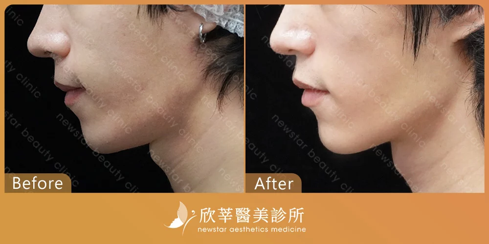 眼部拉提_肉毒案例